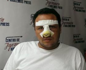 El periodista independiente Roberto de Jesús Guerra Pérez, luego de ser golpeado en La Habana. (Fotografía tomada del Centro de Información Hablemos Press.)