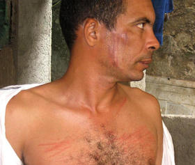 Darsi Ferrer muestra las lesiones que le provocaron agentes de la policía cuando fue arrestado el pasado 9 de julio.