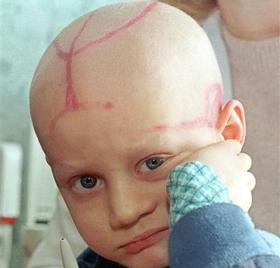 Un niño de cinco años de edad, víctima de leucemia por las radiaciones de Chernóbil